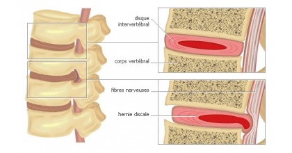 Hernie et Tassement discale