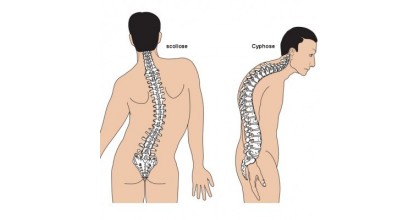 Scoliose et Cyphose