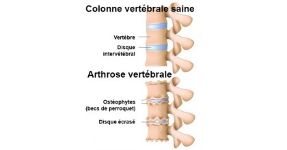 Arthrose du dos