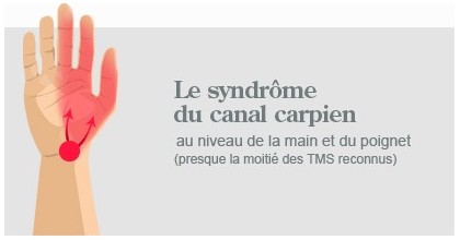 Syndrome Canal Carpien, Guyon