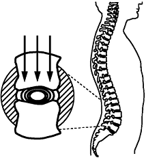 disques intervertébraux